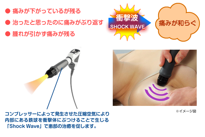 体外衝撃波治療機　マスターパルス　痛みを下げる新しい刺激